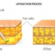 درمان قبل و بعد از لیپوساکشن