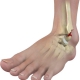 Ankle talus fracture