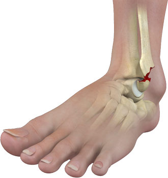 Ankle talus fracture