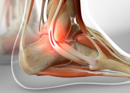 Treatment of peroneal tendon rupture
