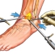 How is ankle arthroscopic surgery performed?