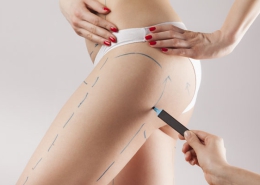 What is leg liposuction and who should use it?