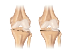 knee osteotomy; The best way to treat knee deviation