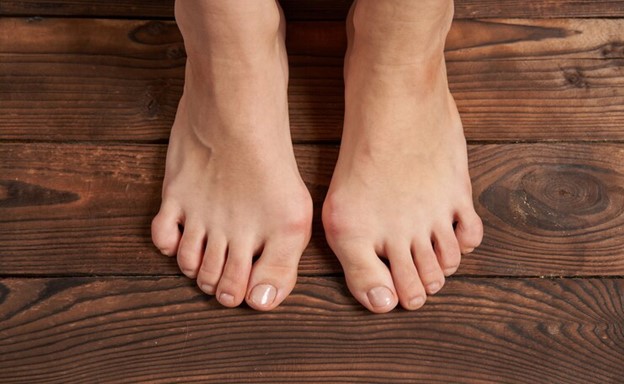 Causes of deviation of the big toe